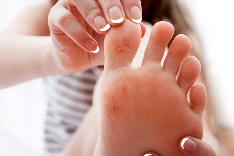 7 Cara Mencegah Kapalan dan Kaki Lecet